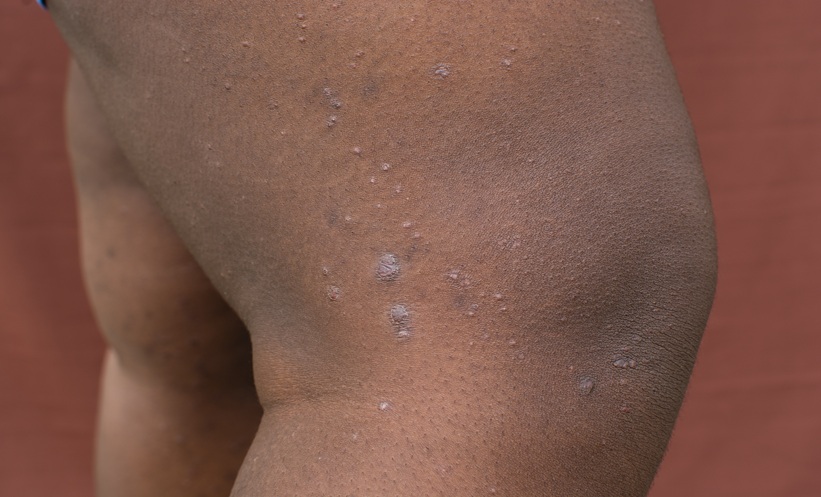 Dupilumab Improves Prurigo Nodularis Severity - EMJ