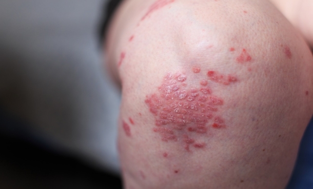 PA2G4 Identified as New Psoriasis Treatment Target - EMJ