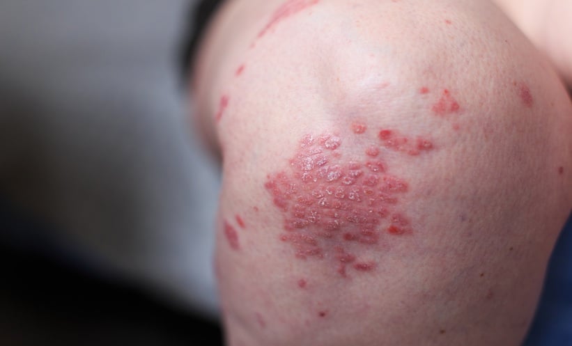 PA2G4 Identified as New Psoriasis Treatment Target - EMJ