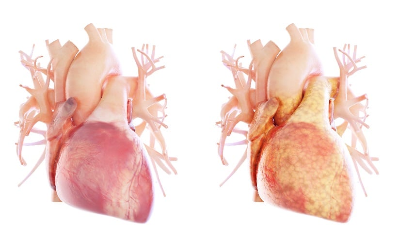 Epicardial fat index predicts HFpEF risk on MRI - EMJ