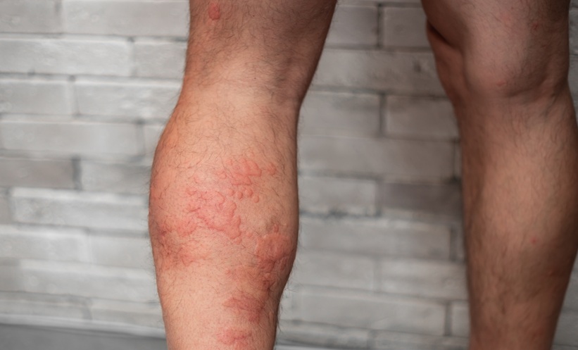 Close-up of adult IgA vasculitis rash on the back of the leg