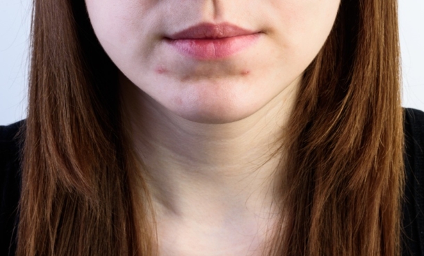 Young girl with acne on her chin.