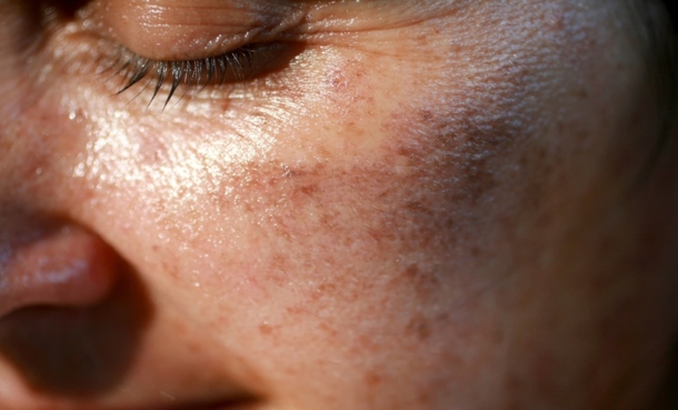 Pigmented spots on the face. Pigmentation on cheeks.
