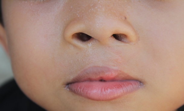 Child with cleft palate receiving developmental assessment and multidisciplinary care consultation