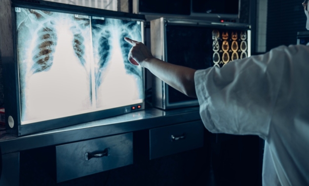 Doctor pointing at a lung X-Ray.
