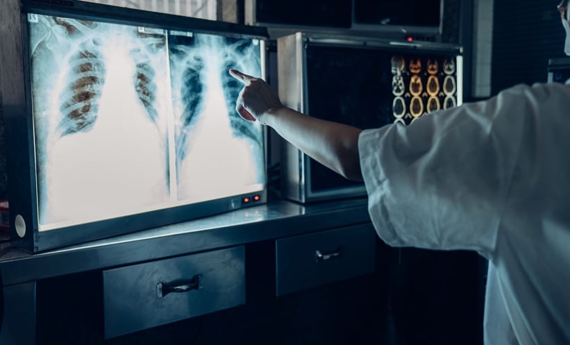 Doctor pointing at a lung X-Ray.