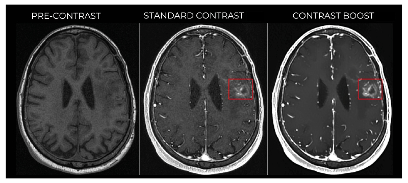 Figure 1 Representative axial T1‑weighted brain MRI showing pre‑contrast (left), standard post‑contrast