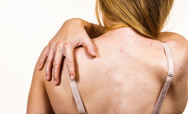 Woman with truncal acne exposing her back.