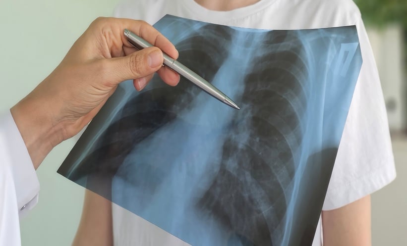 x ray thorax, doctor looks at the picture in the hospital for pneumonia and cancer
