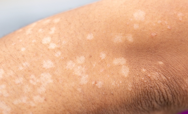 Background image of wounds caused by Systemic Lupus erythematosus (SLE) or Lupus.