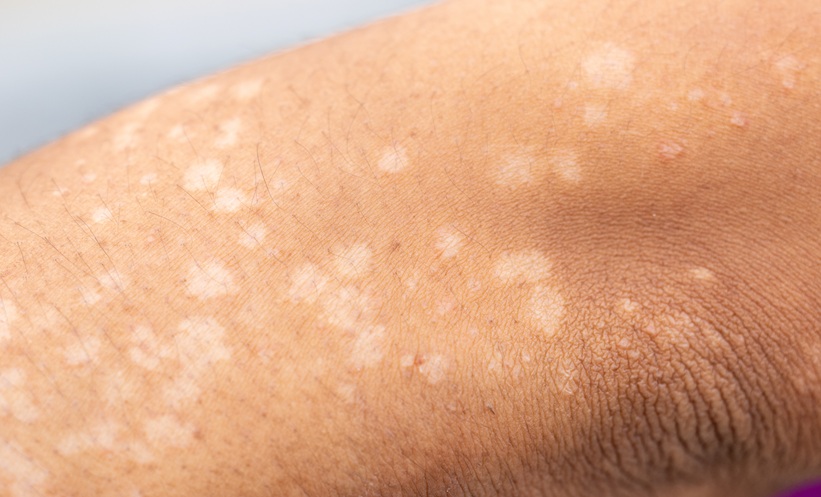 Background image of wounds caused by Systemic Lupus erythematosus (SLE) or Lupus.