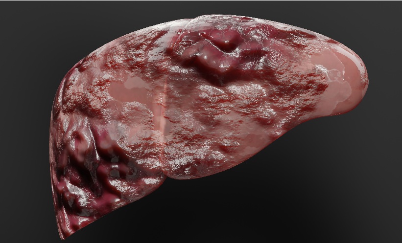 RAAS Inhibitors Lower Liver Cancer Risk in MASLD - EMJ