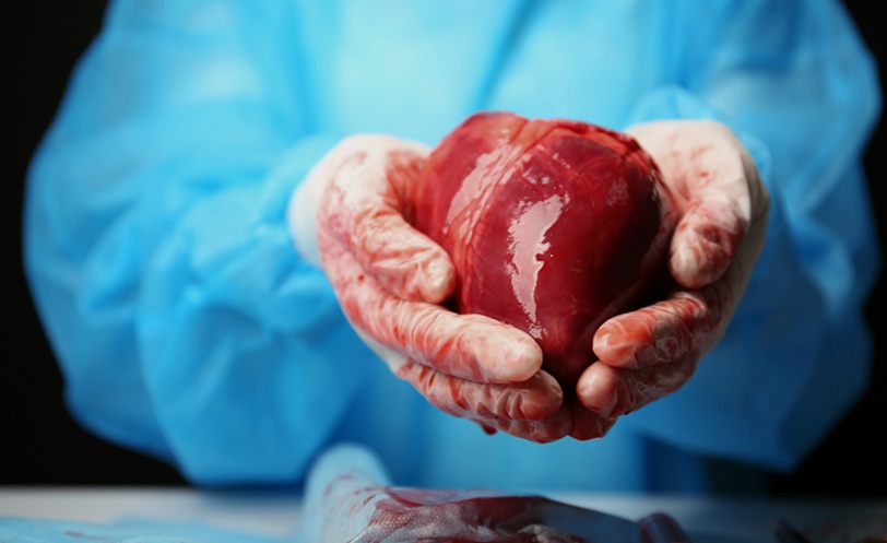 Organ transplant cryopreservation