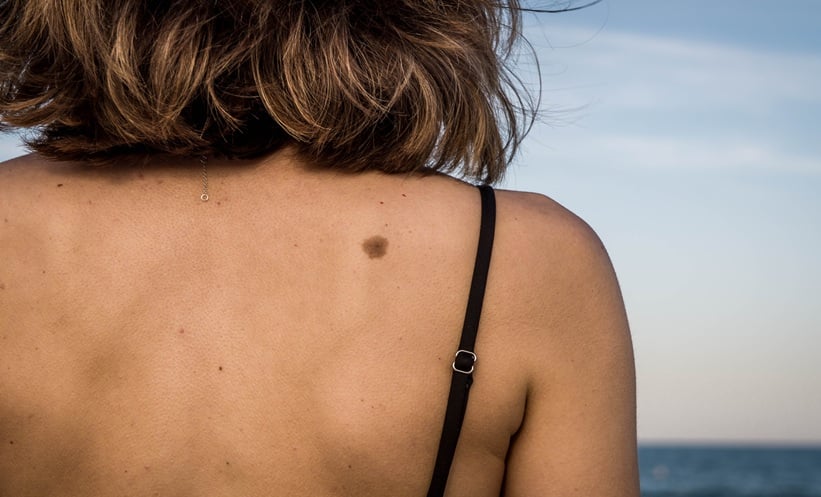 COVID-19 Impact on Melanoma Incidence Trends - EMJ