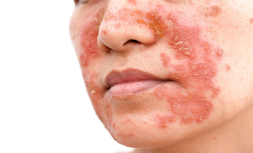Serious Infection Risk in Psoriasis Systemic Treatments - EMJ