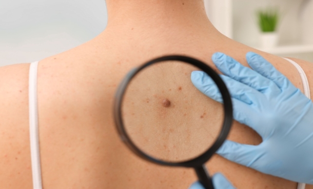 Lentigo Maligna Progression Risk Remains Low - EMJ