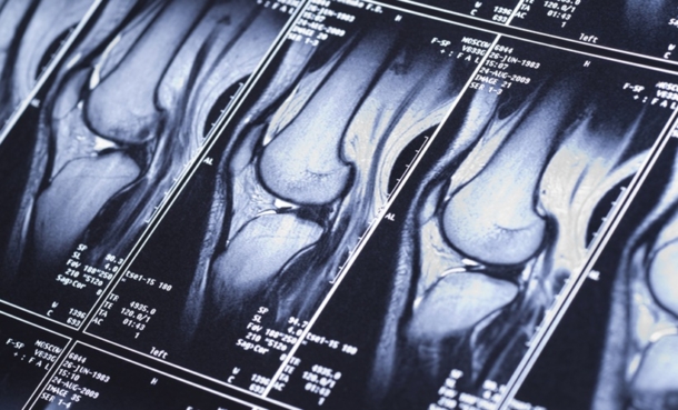 Sacroiliac Bone Marrow Oedema Found in 30% of Healthy Adults - EMJ