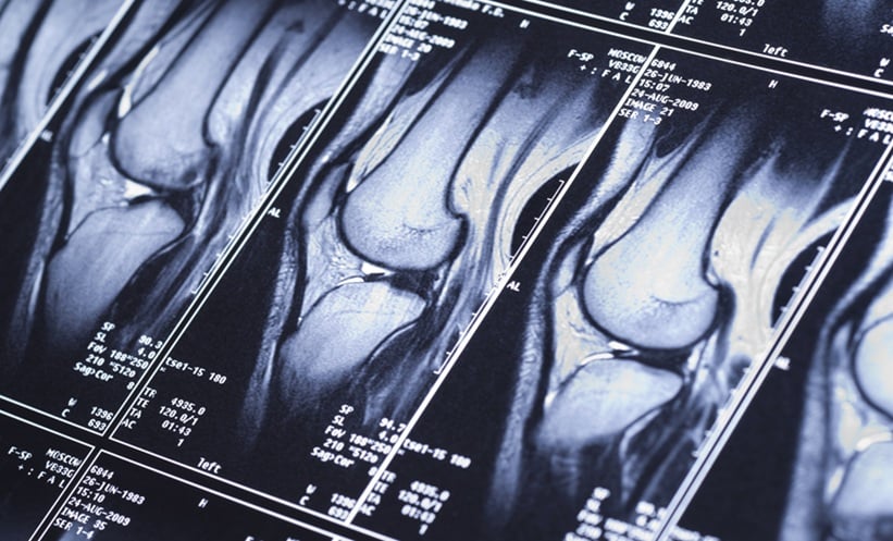 Sacroiliac Bone Marrow Oedema Found in 30% of Healthy Adults - EMJ