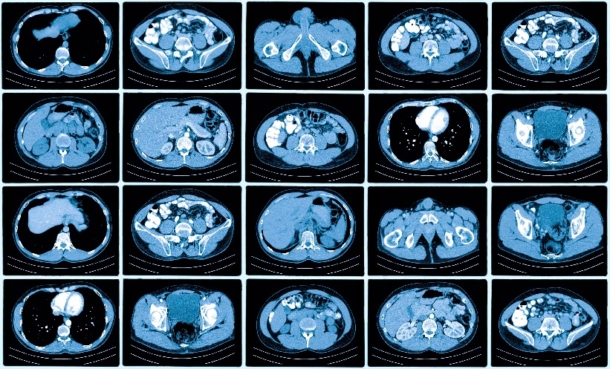 Subtraction CT improves extravasation detection - EMJ