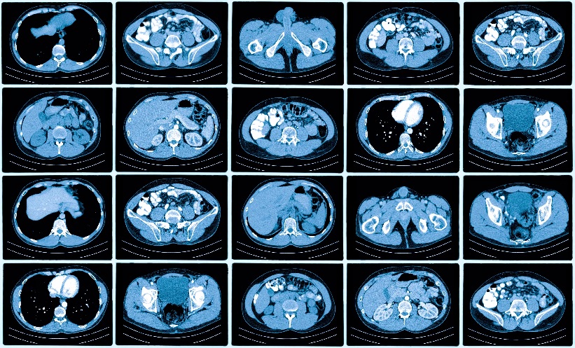 Subtraction CT improves extravasation detection - EMJ