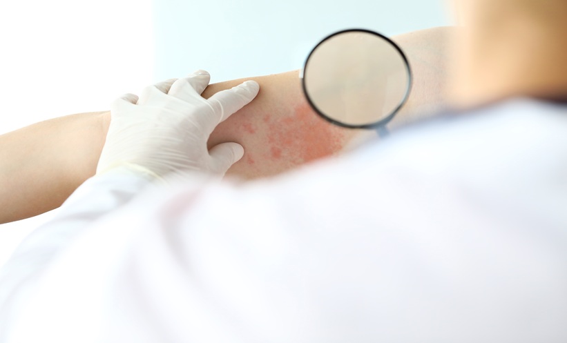 Dermatologist examining inflamed skin during chronic prurigo assessment.