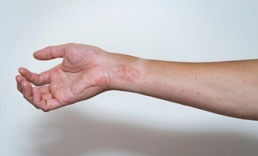 Mild atopic dermatitis rash visible on a patient’s forearm and wrist.