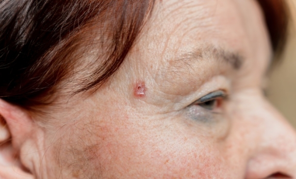 BCNS Quality of Life Impact in Multiple BCC