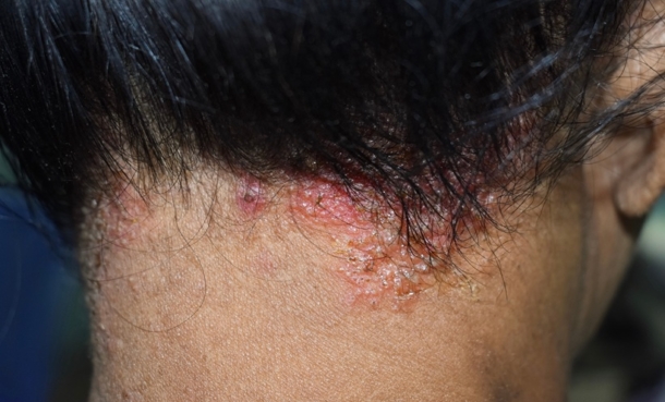 Hair Product Allergens Linked to Microbiome Changes in Scalp Dermatitis