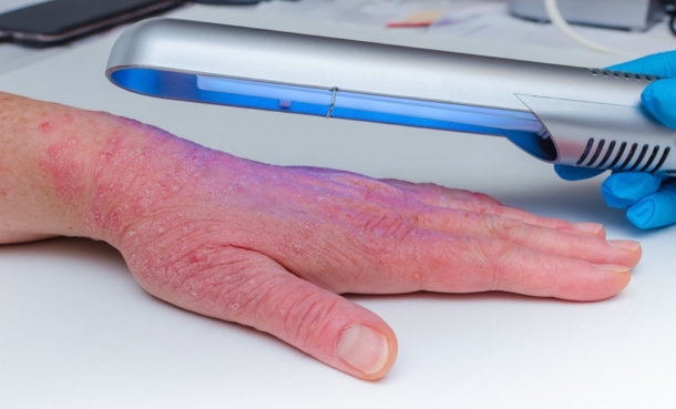 Phototherapy Safety In Elderly Psoriasis Patients - EMJ