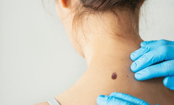 Skin Cancer Diagnosis AI Falls Short of Experts - EMJ