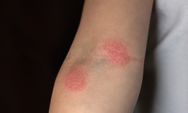 Hypopigmented Mycosis Fungoides Shows Low Risk - EMJ