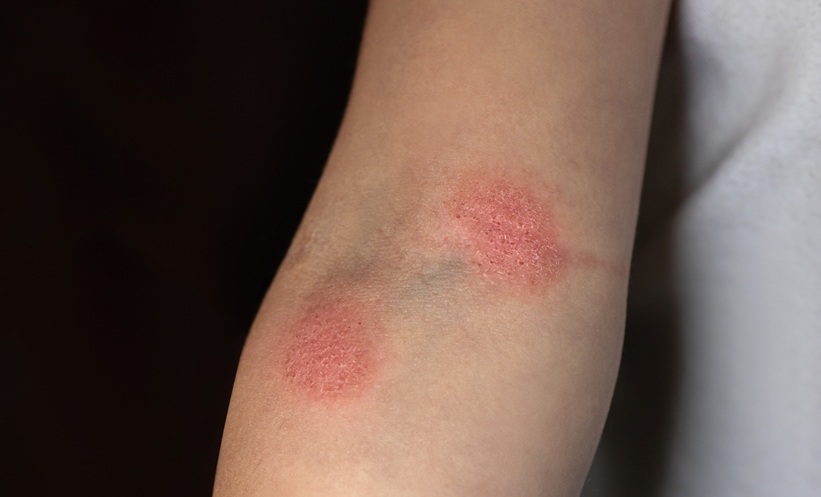 Hypopigmented Mycosis Fungoides Shows Low Risk - EMJ