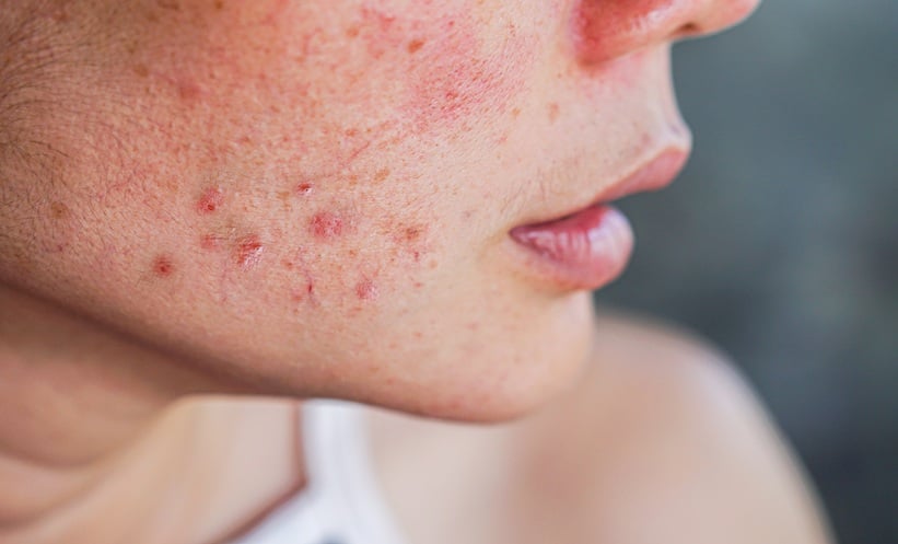 Acne Scar Treatments Compared: Laser vs Microneedling - EMJ
