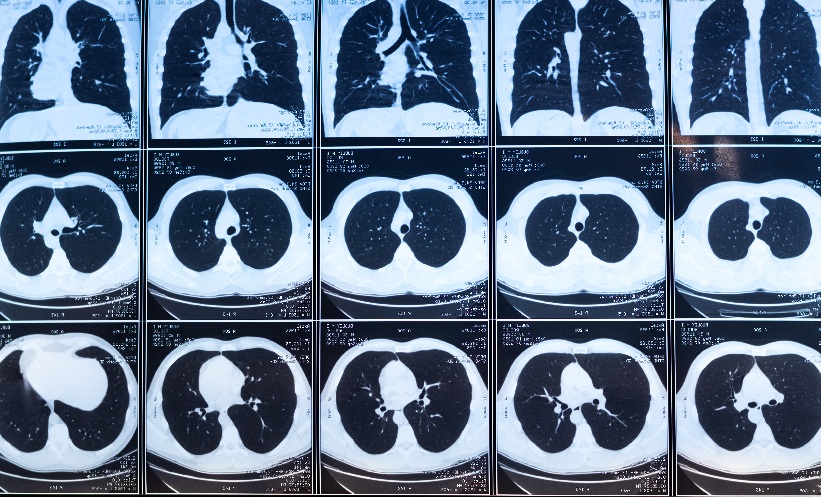 Saline Tract Sealing Reduces Pneumothorax risk - EMJ