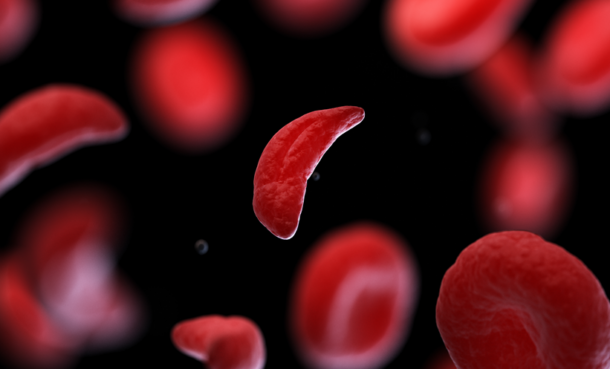 Sickle cell disease