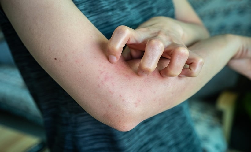 EAACI 2026: B cells in allergic contact dermatitis - EMJ