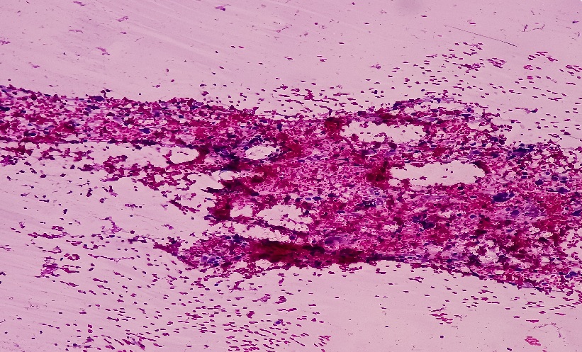 Bile Duct Cancer: PNI Linked to Survival Outcomes - EMJ