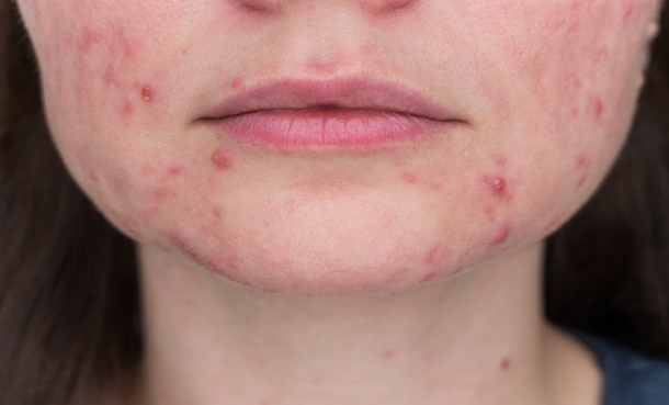 rosacea