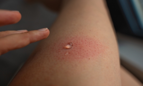 Sertaconazole Nanoemulsion Gel for Fungal Infections - EMJ