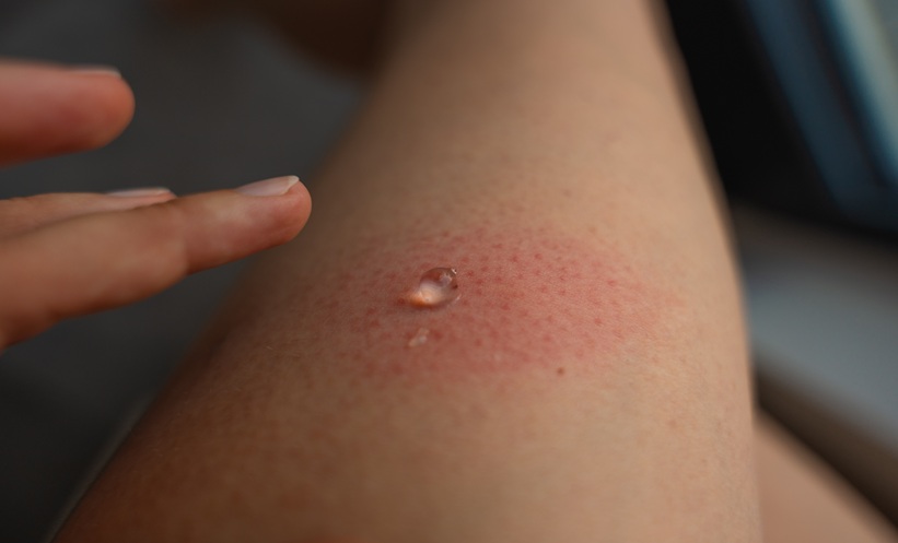 Sertaconazole Nanoemulsion Gel for Fungal Infections - EMJ