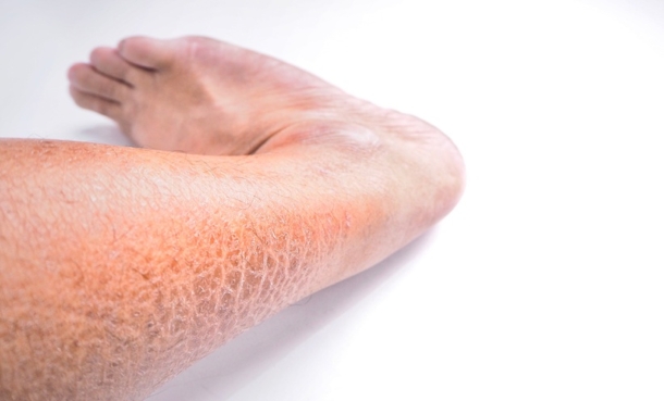 Rare Ichthyosis Burden and Comorbidities in England - EMJ