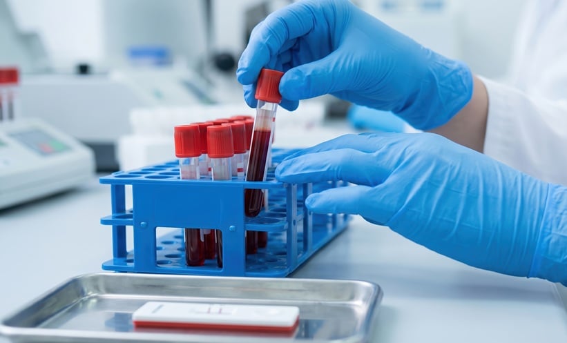 CRP May Predict Drug Response in Axial Spondyloarthritis