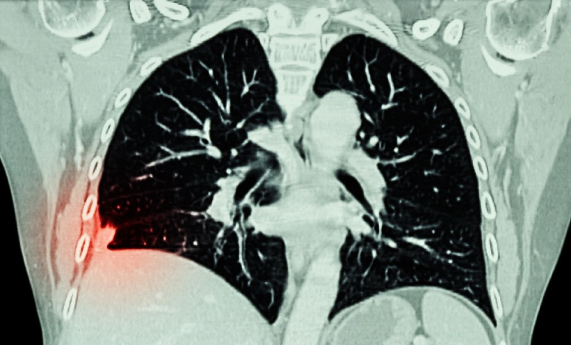 NHS Lung Cancer Screening Scales Imaging Nationwide - EMJ