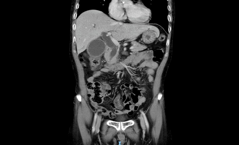 CT Histogram Analysis for Liver Fibrosis Assessment