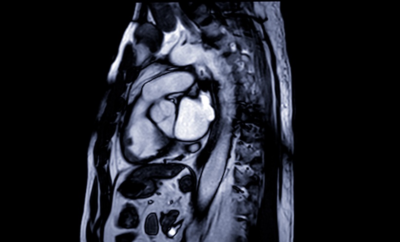 Ferumoxytol Effective Contrast Agent at Low Doses – EMJ