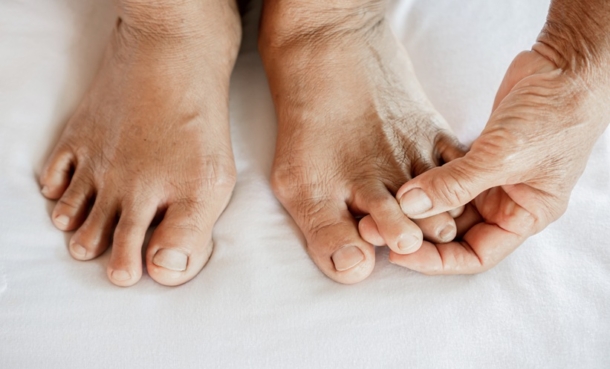 closeup woman feet suffering from joint pain with gout