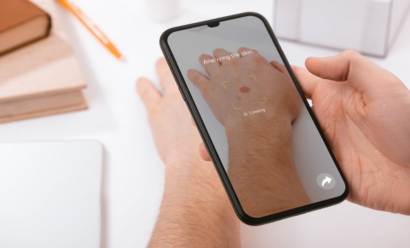 AI assisted skin analysis on a smartphone for intelligent psoriasis research and digital dermatology.