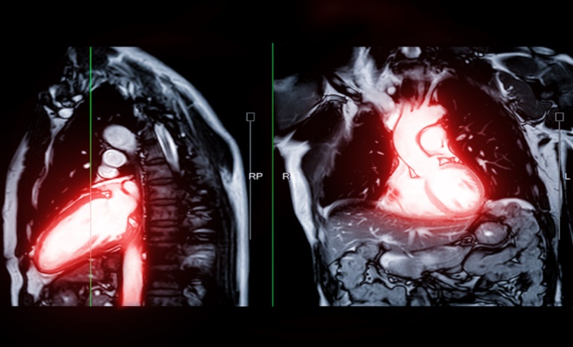 Machine Learning May Improve Arrhythmic Risk Prediction