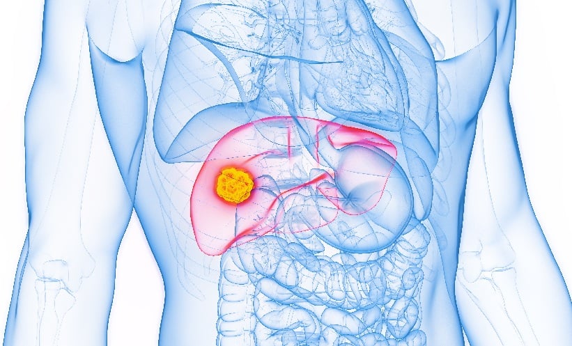Diagram of a person with hepatocellular carcinoma