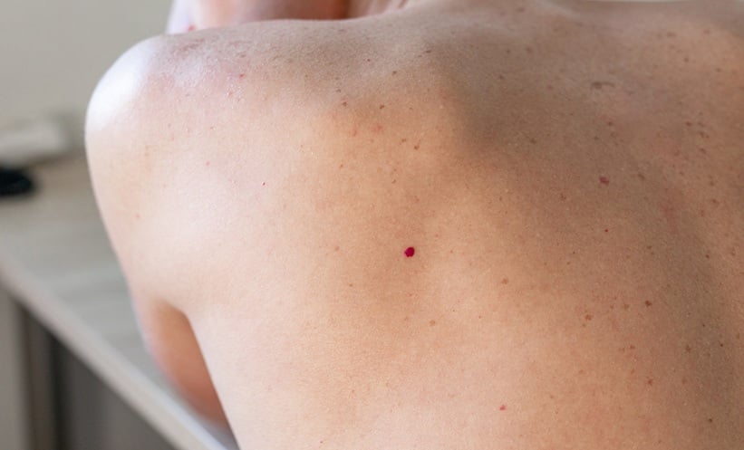Cherry Angiomas and Neurofibromatosis Type 1 - EMJ